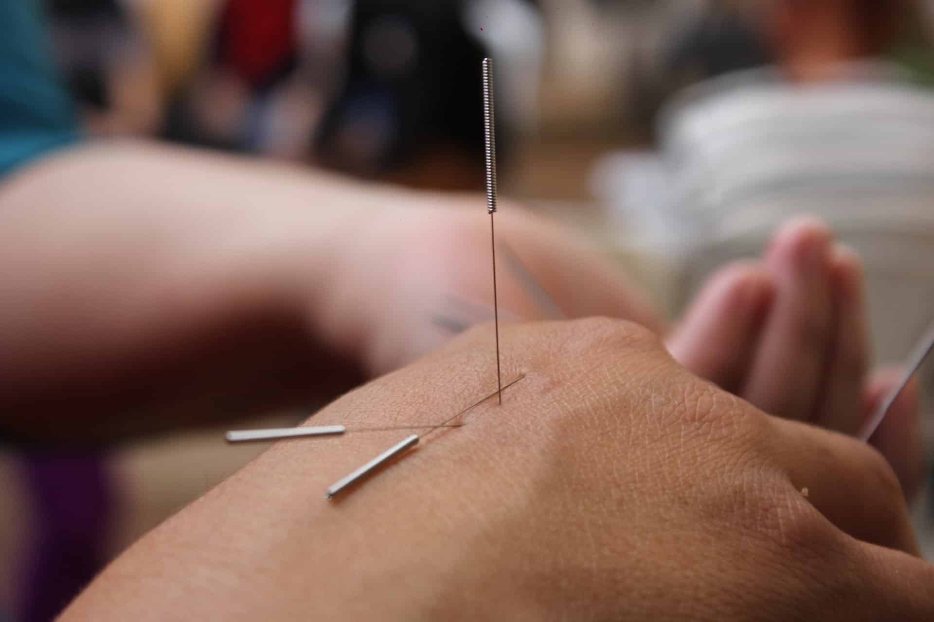 aiguilles d'acupuncture